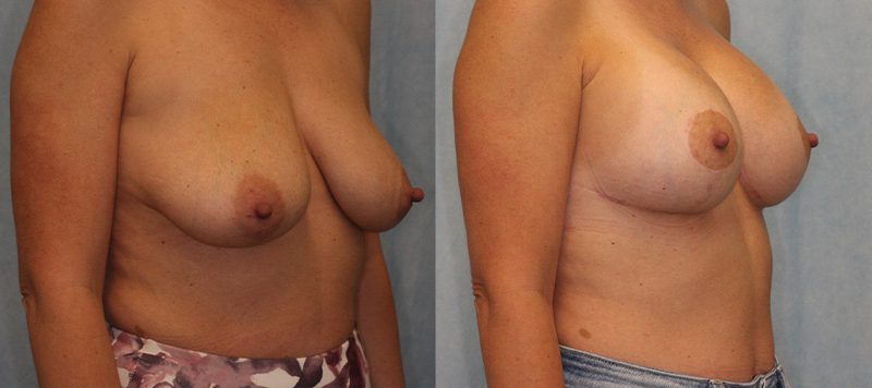 Breast lift Patient 3 Image 2