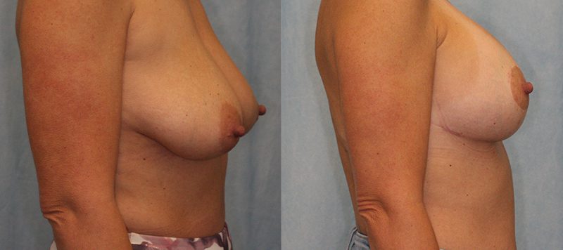 Breast lift Patient 3 Image 1