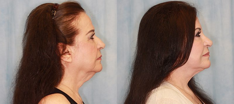 Facelift Patient 3 Image 1