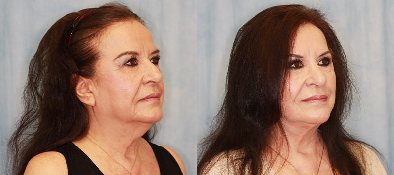 Facelift Patient 3 Image 0