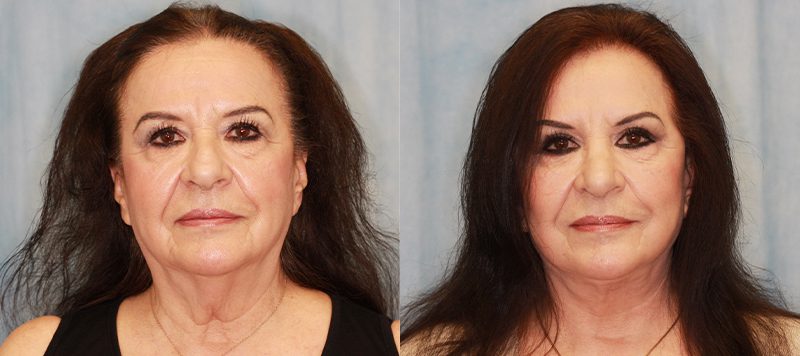 Facelift Patient 3 Image 2