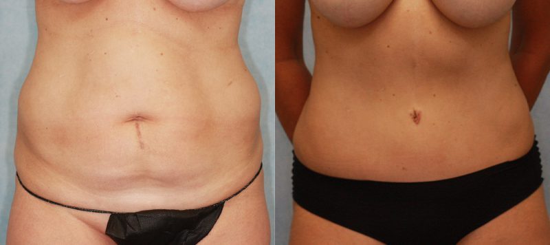 Abdominoplasty Patient 5 Image 0