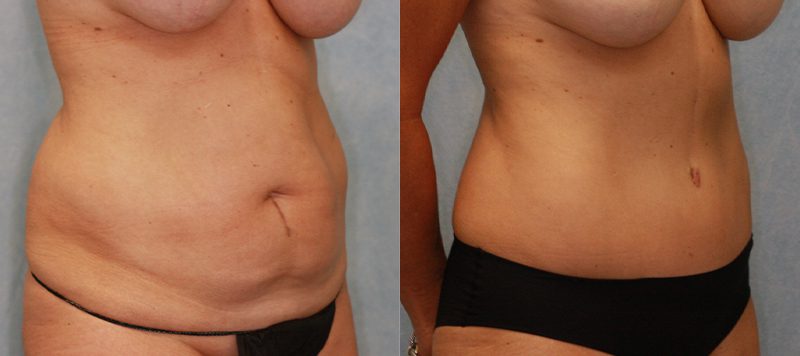 Abdominoplasty Patient 5 Image 2