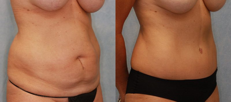 Abdominoplasty Patient 5 Image 1