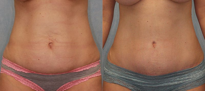 Abdominoplasty Patient 6 Image 1