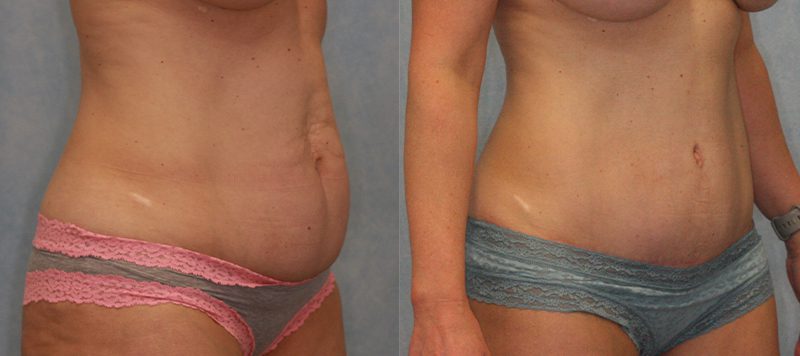 Abdominoplasty Patient 6 Image 0