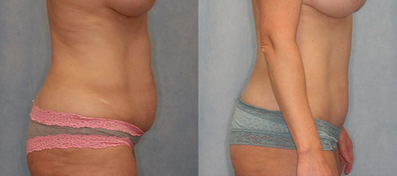 Abdominoplasty Patient 6 Image 2