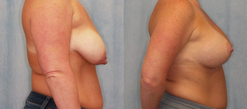 Breast Lift Patient 4 Image 2