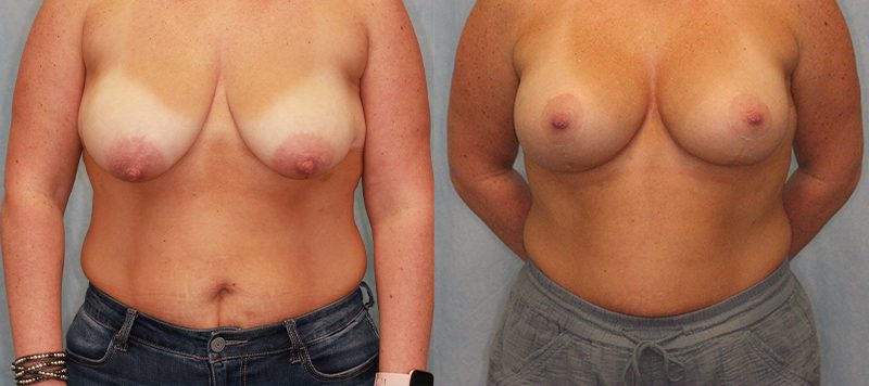 Breast Lift Patient 4 Image 1