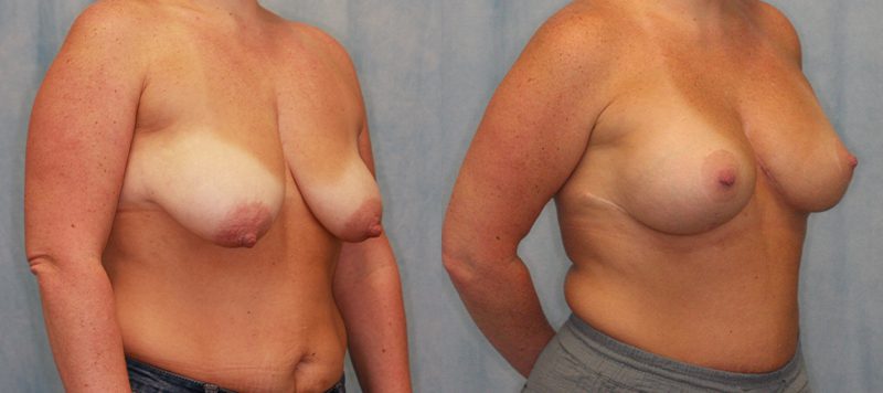 Breast Lift Patient 4 Image 0