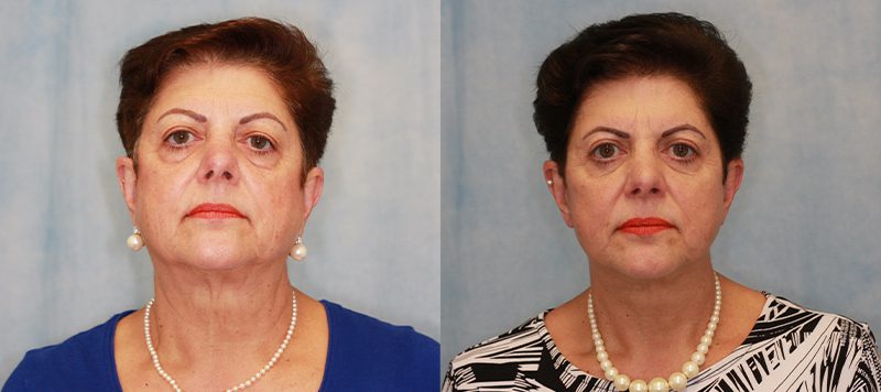 Facelift Patient 2 Image 0