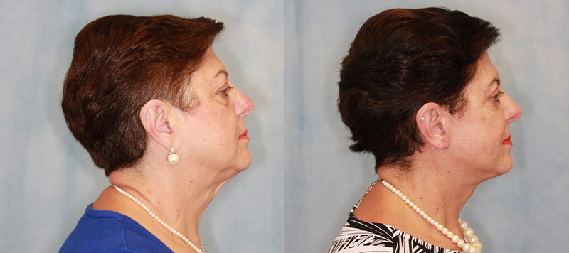 Facelift Patient 2 Image 2