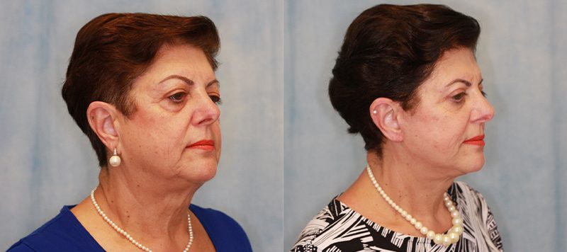 Facelift Patient 2 Image 1