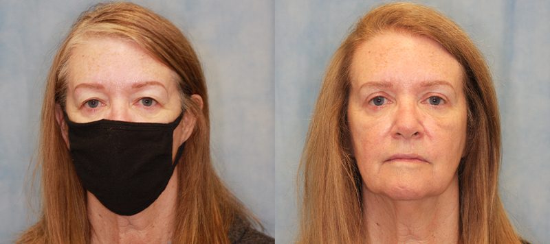 Eyelid Surgery Patient 1 Image 2