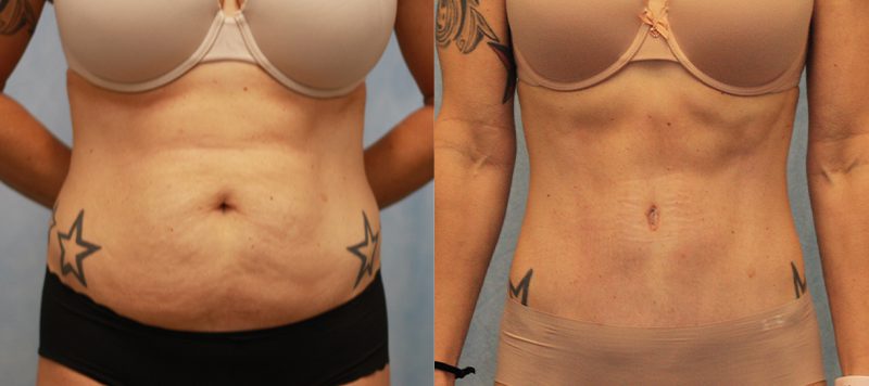 Abdominoplasty Patient 1 Image 2