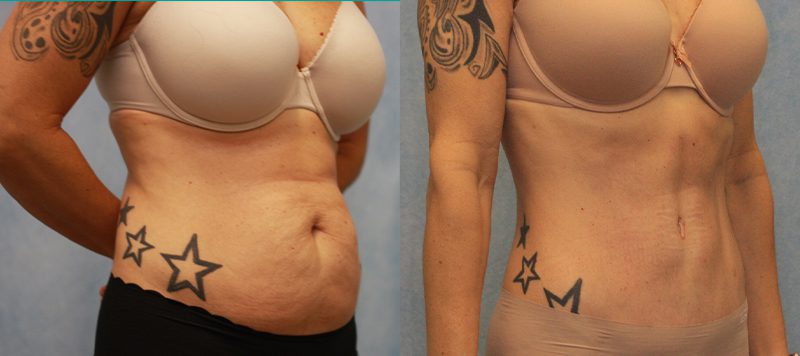 Abdominoplasty Patient 1 Image 1