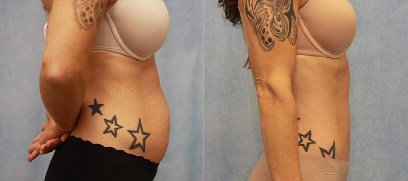 Abdominoplasty Patient 1 Image 0