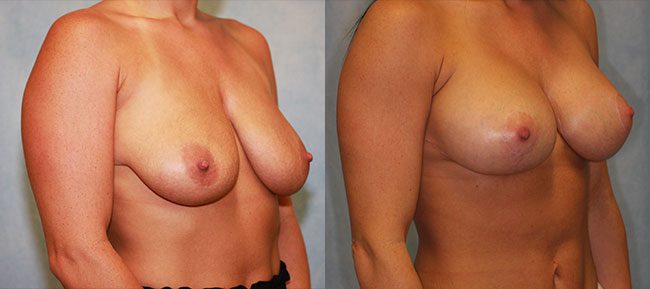 Breast lift With Implants Patient 5 Image 0