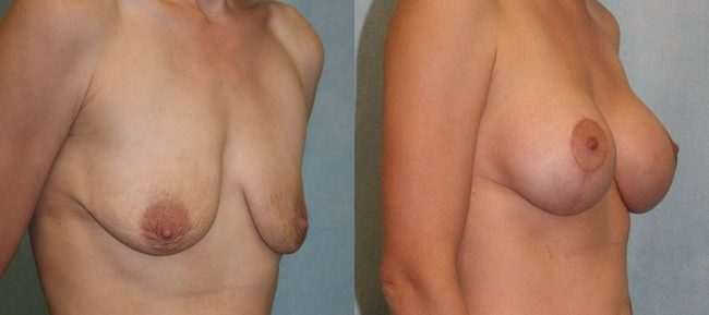 Breast Lift With Implants Patient 3 Image 3