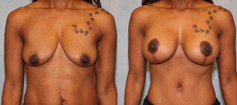 Breast Lift With Implants Patient 7 Image 3