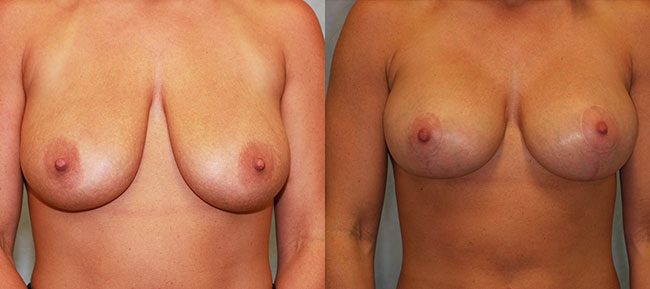 Breast Lift With Implants Patient 6 Image 1