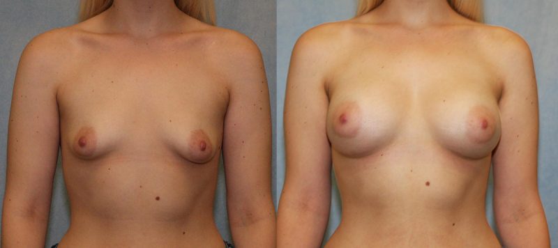 Tubular Breast Correction Patient 2 Image 0