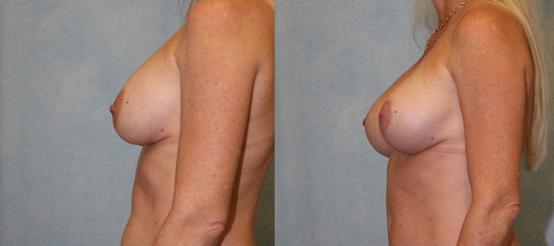 Breast Lift With Implants Patient 2 Image 3