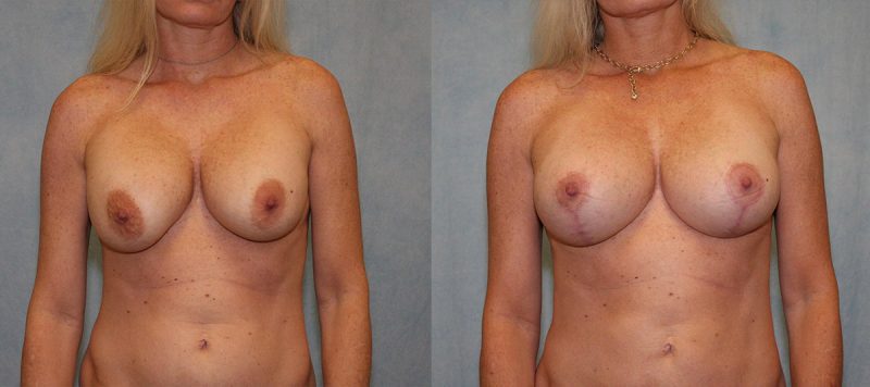 Breast Lift With Implants Patient 2 Image 0