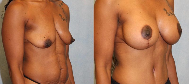 Breast Lift With Implants Patient 7 Image 2