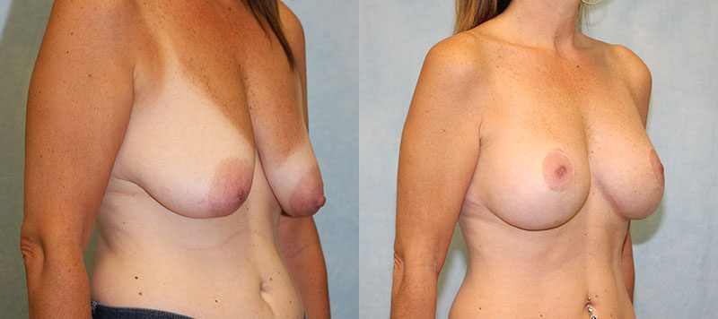 Breast Lift With Implants Patient 1 Image 3
