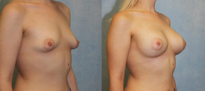 Tubular Breast Correction Patient 2 Image 1