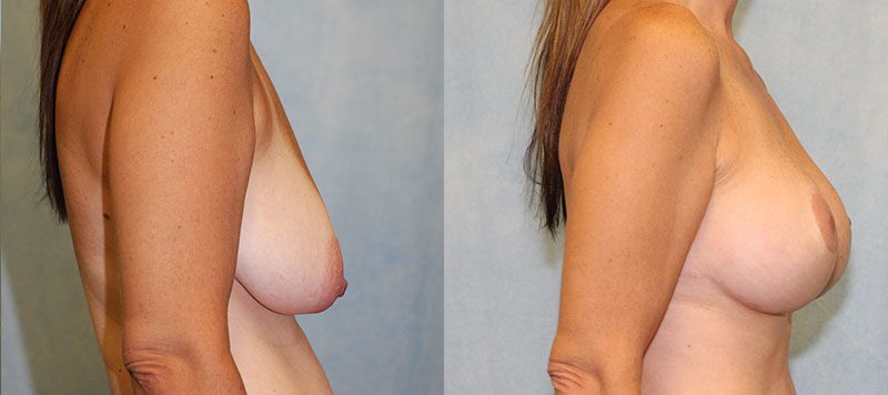 Breast Lift With Implants Patient 1 Image 2
