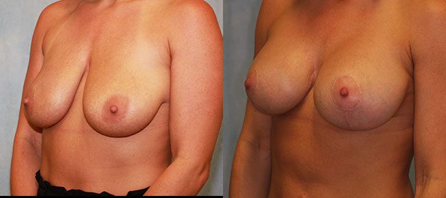 Breast Lift With Implants Patient 6 Image 0