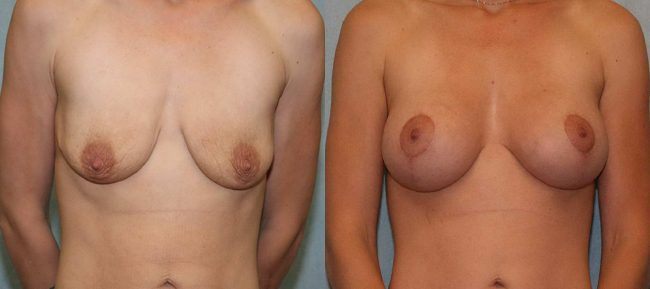 Breast Lift With Implants Patient 3 Image 2