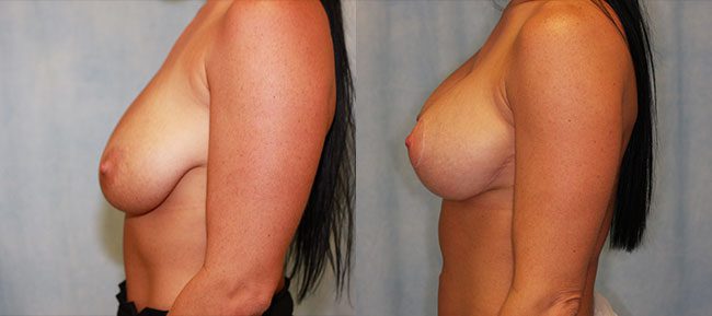 Breast lift With Implants Patient 5 Image 1