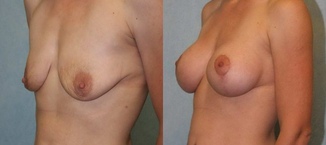 Breast Lift With Implants Patient 3 Image 0