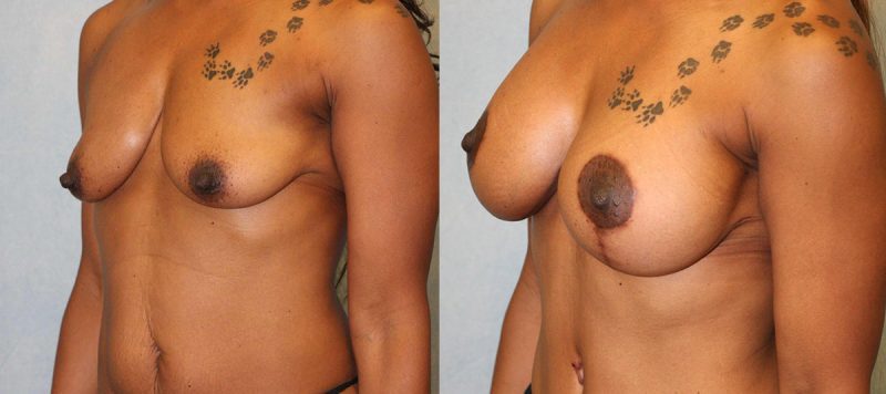 Breast Lift With Implants Patient 7 Image 0