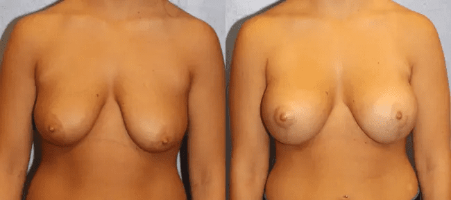 Breast Lift With Implants Patient 4 Image 0