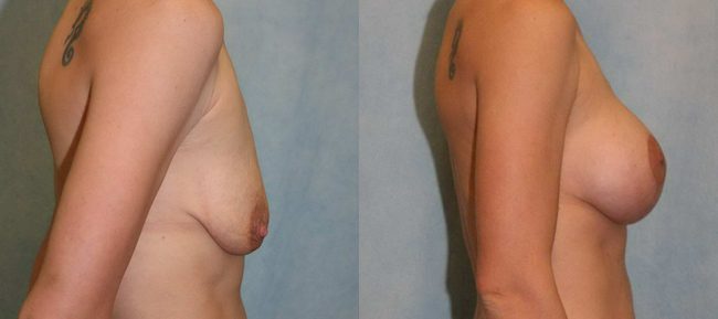 Breast Lift With Implants Patient 3 Image 1