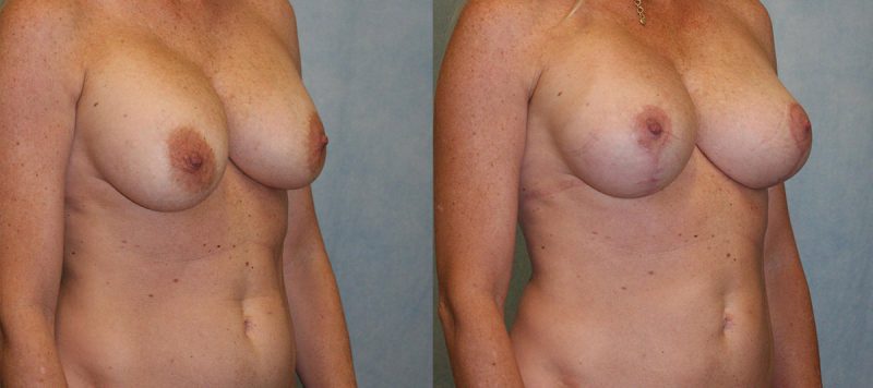 Breast Lift With Implants Patient 2 Image 1