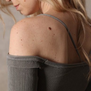 Woman with birthmark on her back