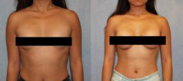 Breast Augmentation Before and After Photo 0