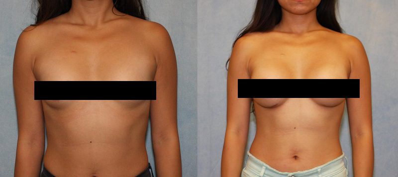 Breast Augmentation Before and After Photo 0