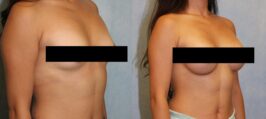 Breast Augmentation Before and After Photo 1