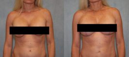 Breast Lift Before and After Photo 0