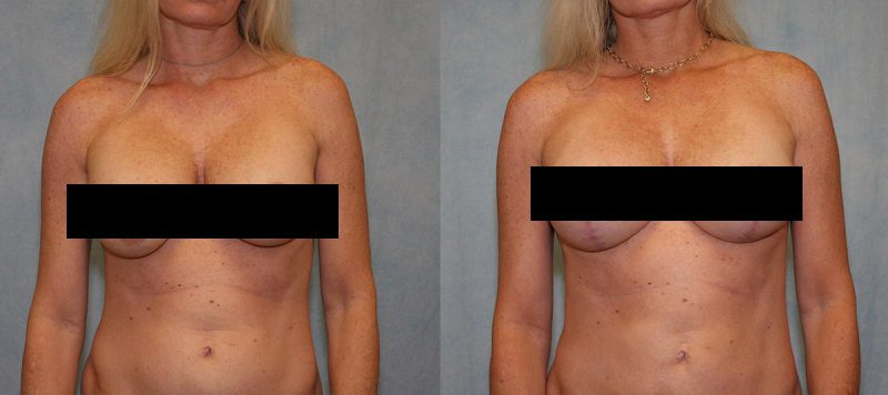 Breast Lift Before and After Photo 0