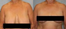 Breast Reduction Before and After Photo 0