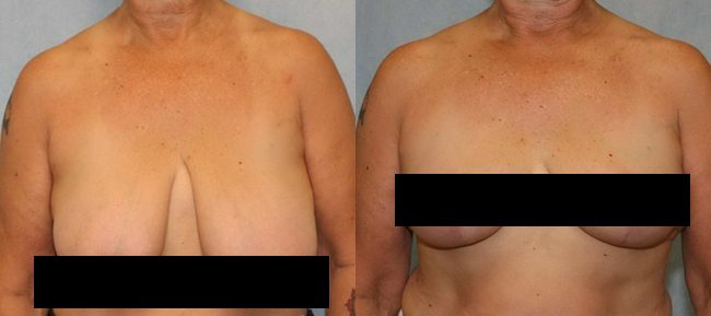 Breast Reduction Before and After Photo 0