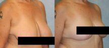 Breast Reduction Before and After Photo 1