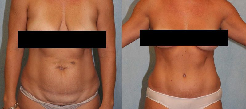 Mommy Makeover Before and After Photo 0